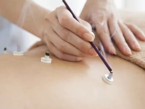お灸による施術の様子
